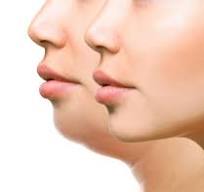 تزریق ژل چانه در شیراز